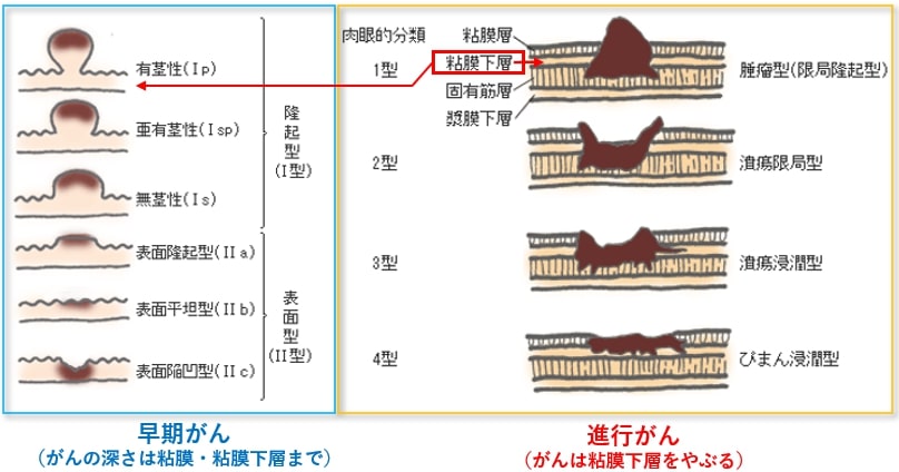 大腸がんの診断