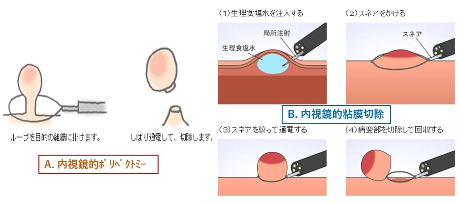 ポリペクトミー・内視鏡的粘膜切除（EMR）