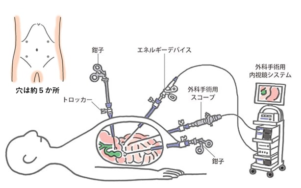 腹腔鏡下大腸切除術