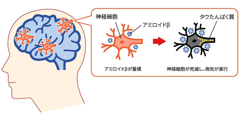 脳のなかの老廃物