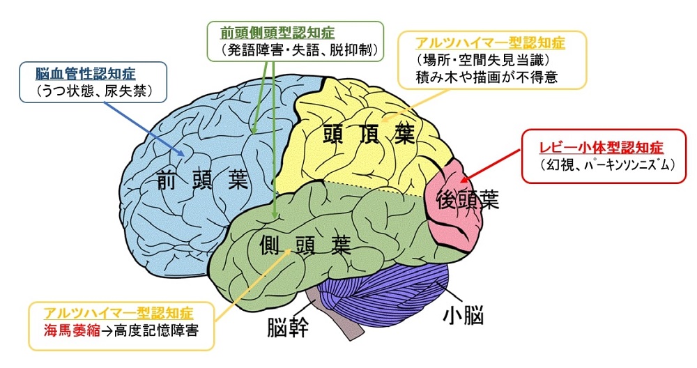 認知症の病型と脳血流が低下する場所（大脳を側面から見た図）