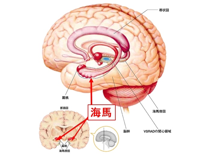 脳血管性認知症（VD）