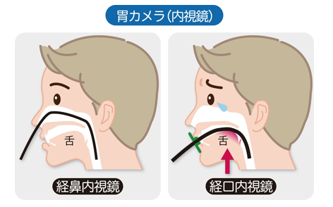 鼻からの胃カメラ検査（経鼻内視鏡）