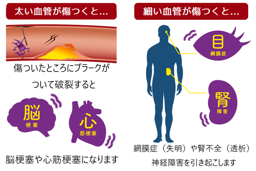 糖尿病は、失明(網膜症)・人工透析(腎不全)・足の切断(動脈硬化)につながります