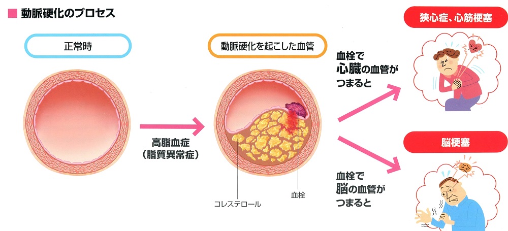 高コレステロール血症（脂質異常症）