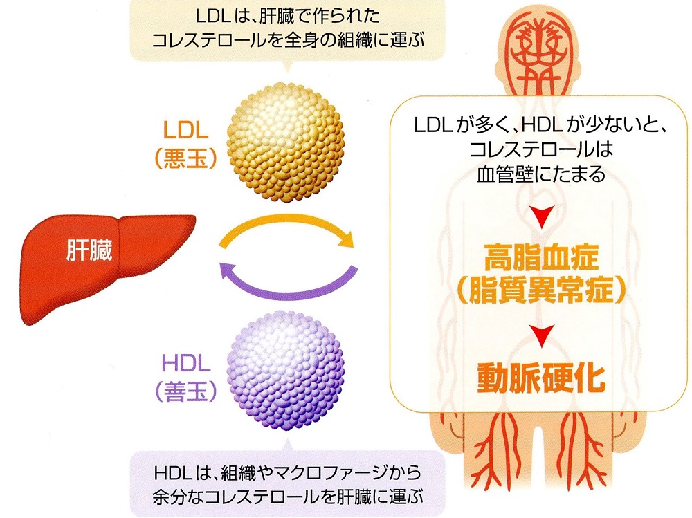 高コレステロール血症（脂質異常症）