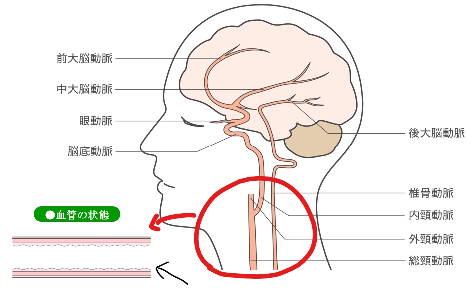 高コレステロール血症（脂質異常症）