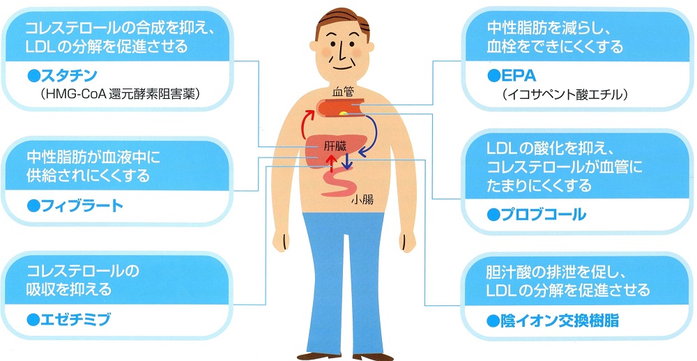 高コレステロール血症（脂質異常症）治療