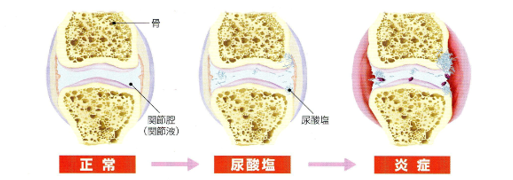 高尿酸血症・痛風とは