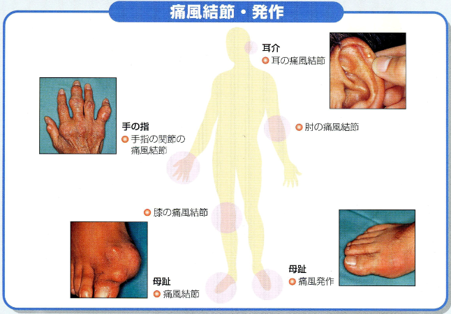 対処 痛風 痛風は初期の対応が大切！痛風になってしまった時にすることとは？