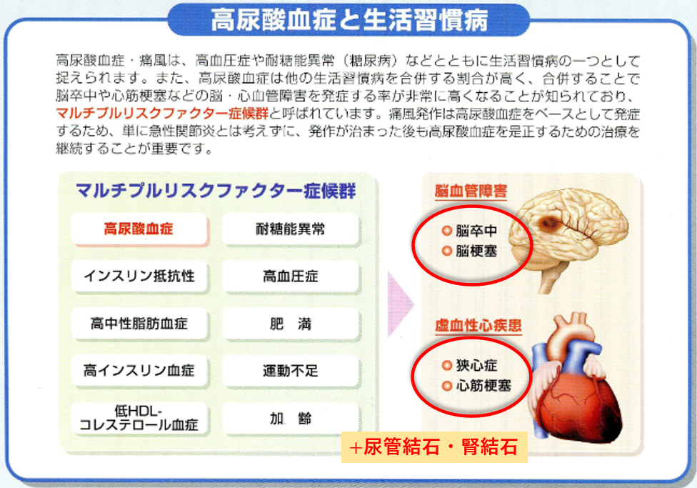 高尿酸血症を放置すると、脳卒中や心筋梗塞、尿管結石の危険が高まります！