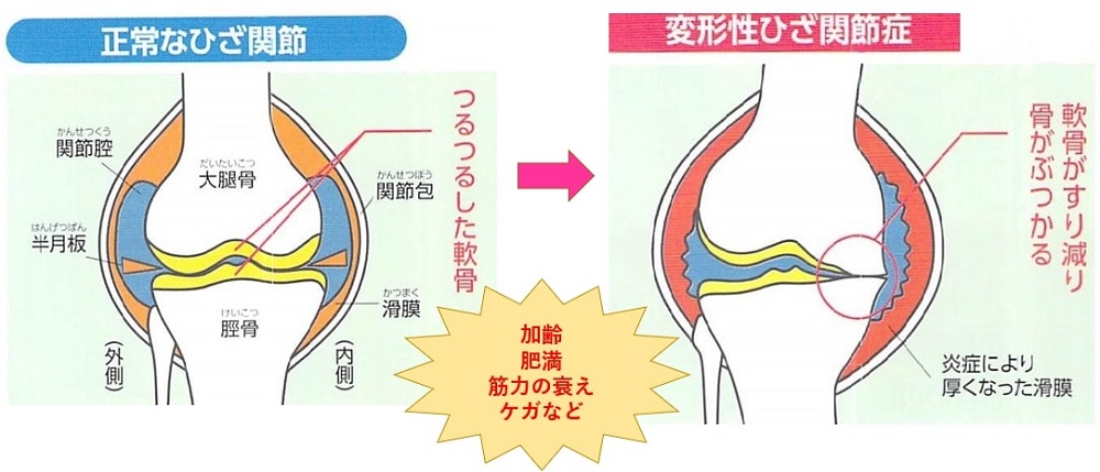 変形性ひざ関節症とは