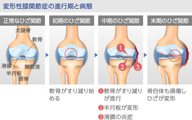 変形性ひざ関節症とは