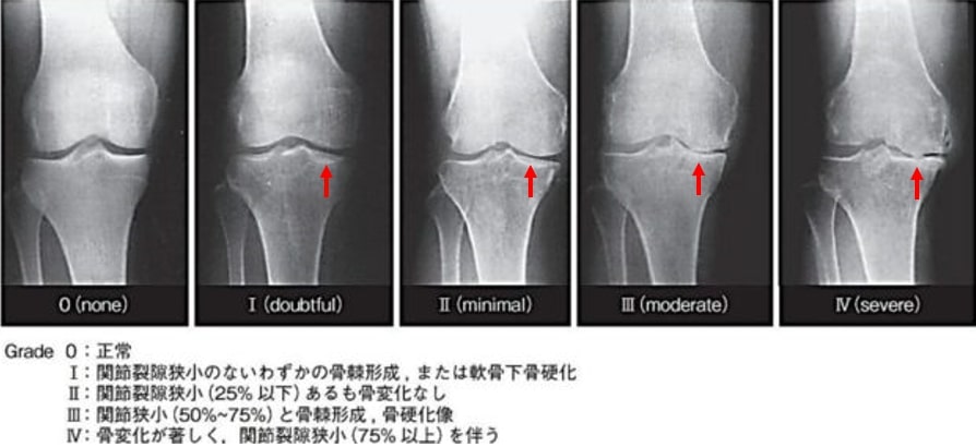 変形性ひざ関節症とは