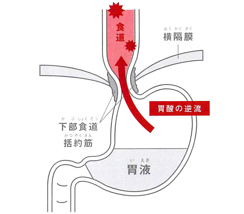 逆流性食道炎（ぎゃくりゅうせいしょくどうえん）