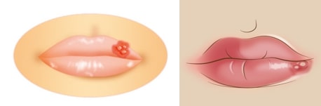 治し 方 炎 口唇 口唇炎の体験談、巨大な口唇炎、塩こすり＆チョコラBBで治療