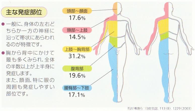 帯状疱疹（たいじょうほうしん）とは