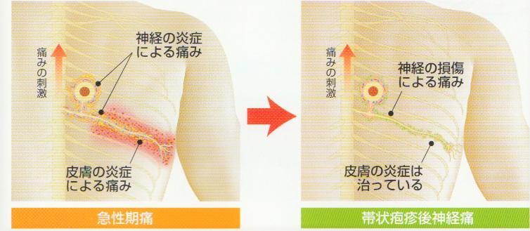 やっかいな後遺症（帯状庖疹後神経痛）