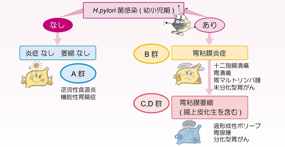 ピロリ菌感染と胃病変の関連